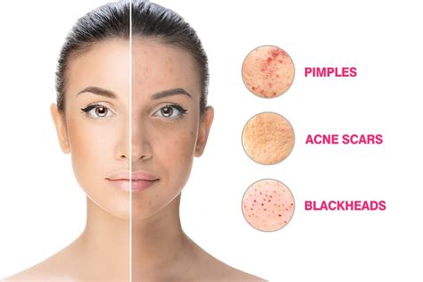 Types Of Acne Scars : Types of Acne Scars and How to Treat Them : Atrophic scars are the most ...