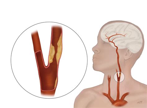 TCAR Procedure - Savannah Vascular Institute