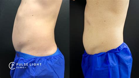 CoolSculpting Fat Freezing Abdomen | Pulse Light Clinic London