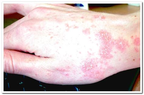 What is canine scabies? Contagion, duration and treatment - Dogsis