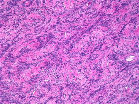 Webpathology.com: A Collection of Surgical Pathology Images