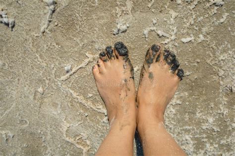 Therapeutic Mud. Mud Foot Treatment. Arthritis and Arthrosis Treatment. Stock Image - Image of ...