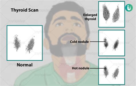 Thyroid Scan