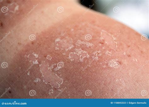 Peeling Skin at Back and Shoulder from Sunburn Effect Stock Image - Image of melanoma, beach ...