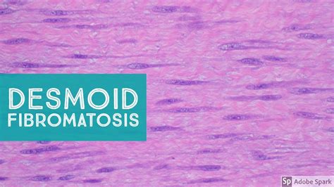 Desmoid-type Fibromatosis (Desmoid Tumor) - Explained by a Soft Tissue ...