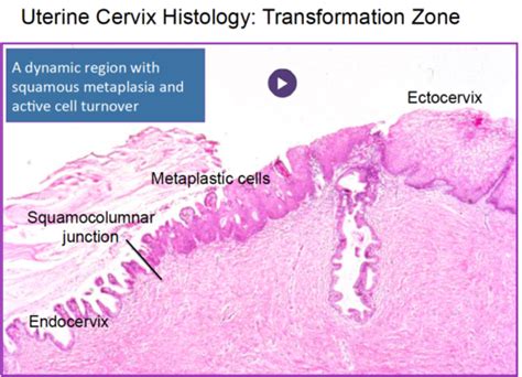 Cervical/Vaginal - Squamous lesions Flashcards | Quizlet