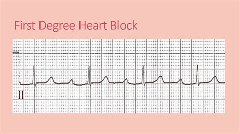 Study Medical Photos: ECG Findings In Different Types Of Heart Block.