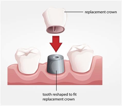 Procedure for Dental Crowns