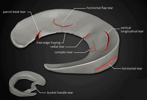 The Complete Guide to a Meniscus Tear - Kinetic Labs | Toronto Physiotherapy, Chiropractic and ...