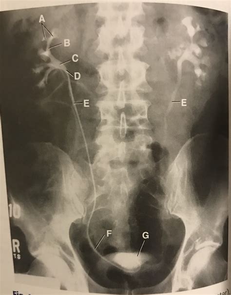 Retrograde pyelogram Diagram | Quizlet