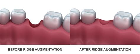 Ridge Augmentation