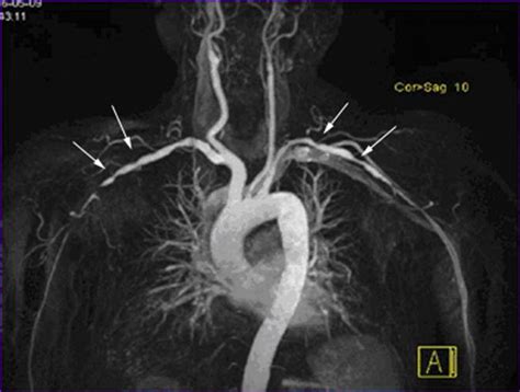 MRI/MRA Neck - Los Angeles, CA | Cedars-Sinai