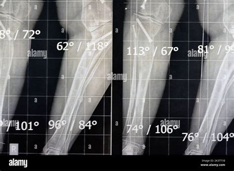 Plain x ray long film standing position showing both legs with bilateral metaphyseal genu varum ...