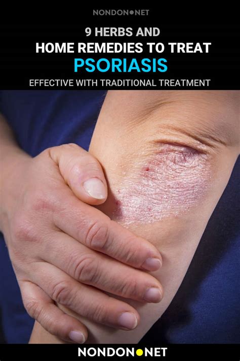 9 Herbs and Home Remedies to Treat Psoriasis Naturally