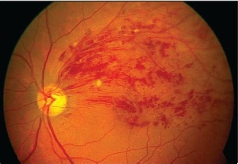 Central Retinal Artery Occlusion Vs Normal