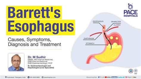 Barrett's Esophagus – Symptoms, Causes, Types And, 51% OFF