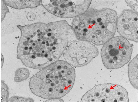 Jacobsen/Paris-Trousseau Syndrome: Report of a Case with Emphasis on Platelet’s Light ...