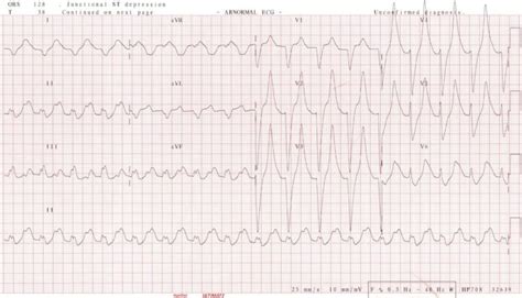 Hyperkalaemia Clinical Case • LITFL • Clinical case