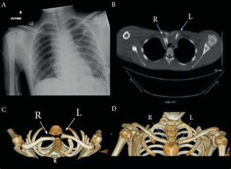 Cureus | Emergent Management of Traumatic Posterior Sternoclavicular Joint Dislocation: A Case ...