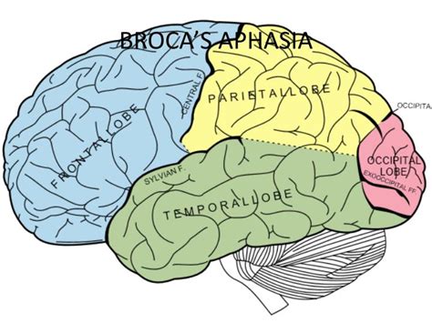 PPT - BROCA’S APHASIA PowerPoint Presentation - ID:2929468