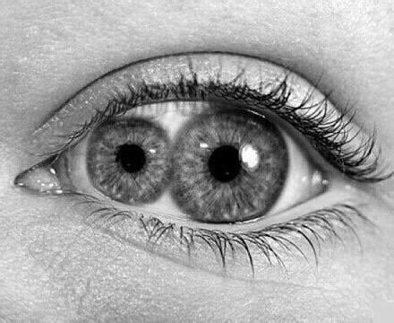 Double pupil - Polycoria - is a rare congenital defect of the eye: the presence of two or more ...