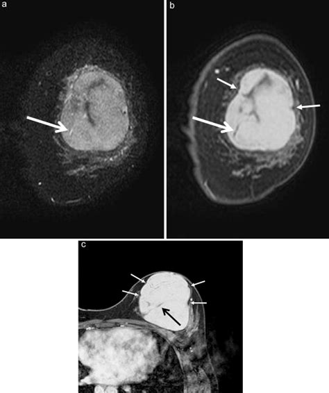 Differentiation between benign phyllodes tumors and fibroadenomas of the breast on MR imaging ...