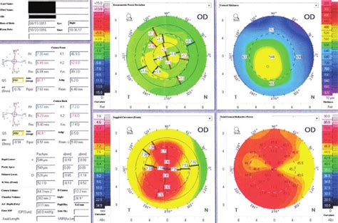 Corneal topography map of the right eye | Download Scientific Diagram