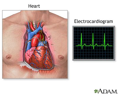 Electrocardiogram Information | Mount Sinai - New York