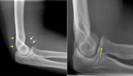 Anatomy Standard Radius : Radius – Anterior And Posterior Views – Human Body Help | Bodwasuod