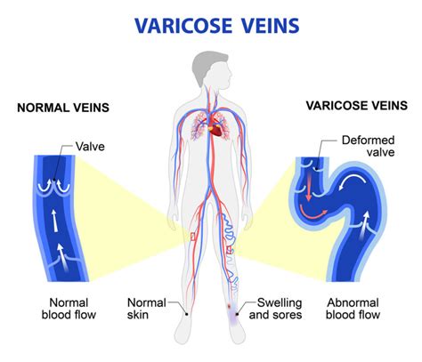 Venous Reflux Disease | Comprehensive Vascular Specialists | La Jolla Vein & Vascular