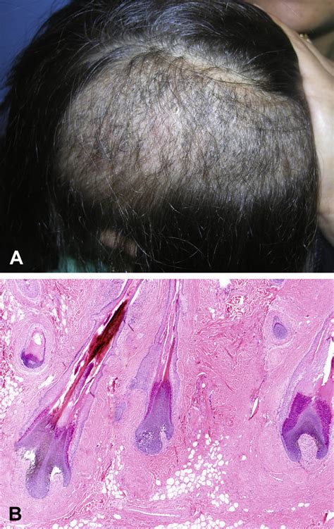 Pili multigemini/trichofolliculoma-like organoid nevus. Clinical ...