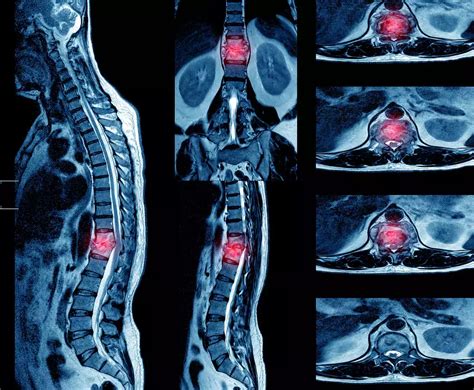 Spondylodiscitis Treatment in Mumbai at One Spine Clinic