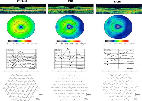 Clinical example of a healthy control, an eye from the DRF, and an eye ...