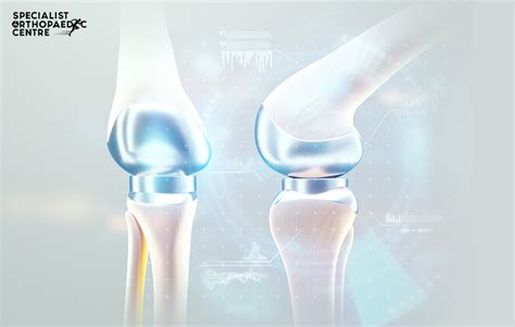 Partial vs Total Knee Replacements | Specialist Orthopaedic Centre