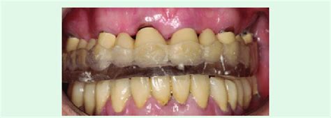 Occlusal splint after 2 years of service. | Download Scientific Diagram