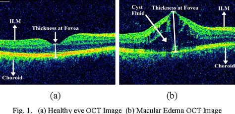 Fully automated assessment of Macular Edema using Optical Coherence Tomography (OCT) images ...