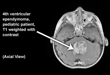 Pediatric Ependymoma Images | CERN Foundation