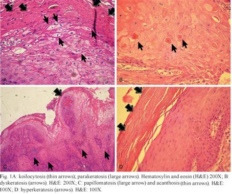 SciELO - Brasil - Correlation between koilocytes and human papillomavirus detection by PCR in ...