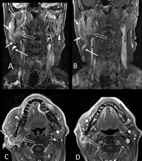 Cureus | Primary Parotid Tumor Thrombosis: Immunohistologic Features ...