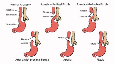 Image result for esophageal atresia with a tracheoesophageal fistula | Nursing | Pediatric ...