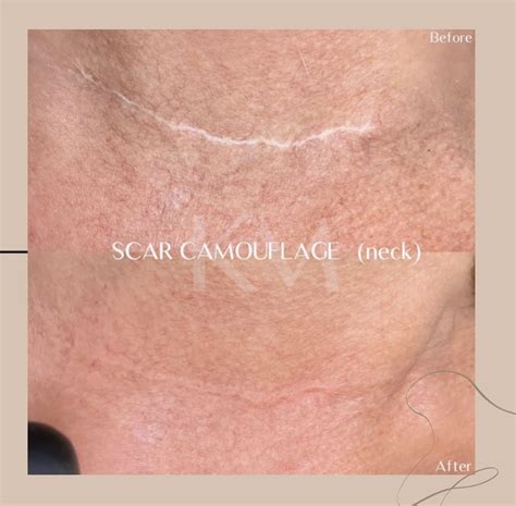 Scar Camouflage — Karina Michele