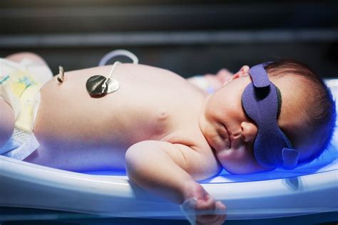 Newborn With Jaundice Treatment at Dick Spitzer blog