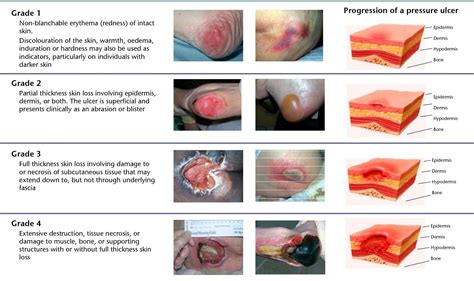 All Grades of Bed sore | Surgery | Dr Nilesh Mori | Bed sores, Pressure ulcer, Wound care