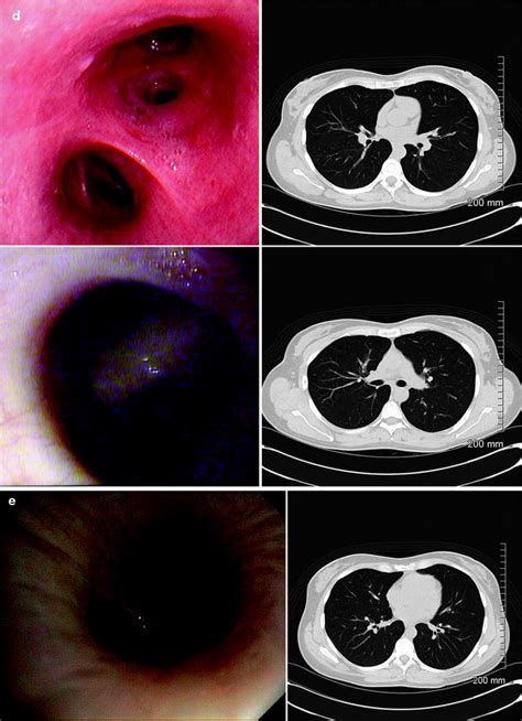 Airway Anatomy | Radiology Key