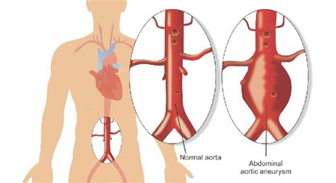 Fenestrated endovascular aneurysm repair - Norton Healthcare Provider ...