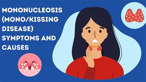 Mononucleosis (Mono/Kissing Disease): Symptoms and Causes | Sprint Medical