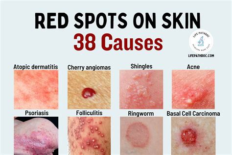 Red Spots on Skin: 38 Causes, Pictures, and Treatment