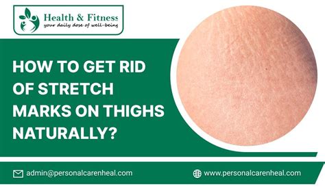 How to Get Rid of Stretch Marks on Thighs Naturally?