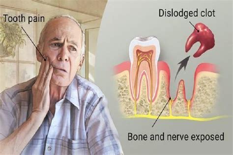 Can You Get Dry Socket After Tooth Extraction? - Coral Dental Care