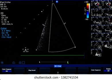 Cardiac Ultrasound Images Screen Echocardiography Machine Stock Photo ...